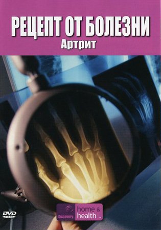 Рецепт от болезни: Артрит / Discovery: The Body Invaders: Arthritis (2001)SATRip